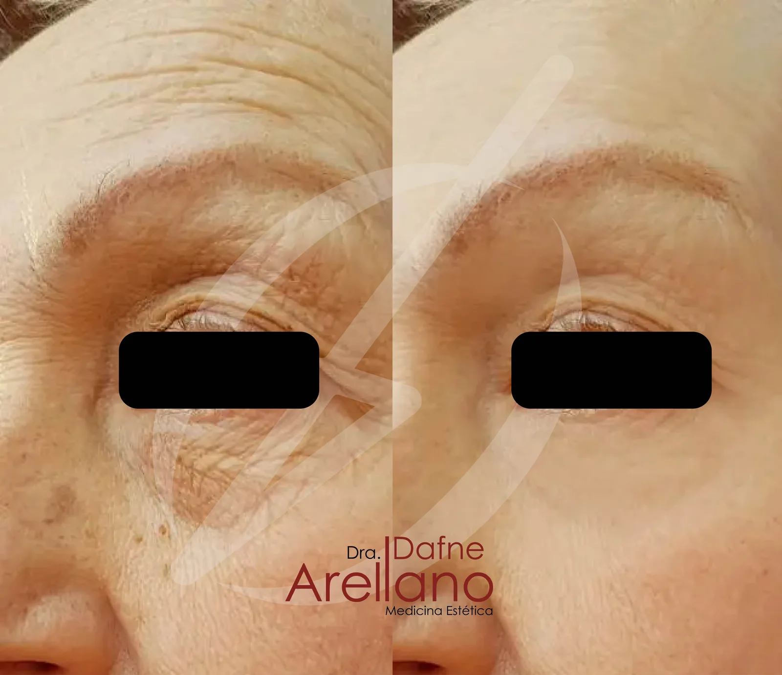 Antes y después · Nctf Hialuronic Pen
