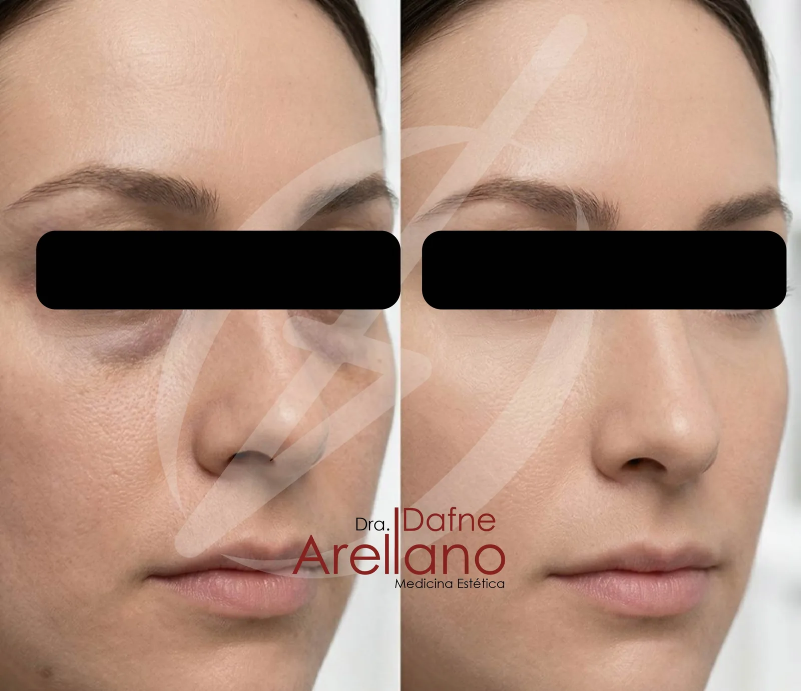 Antes y después · Ojeras