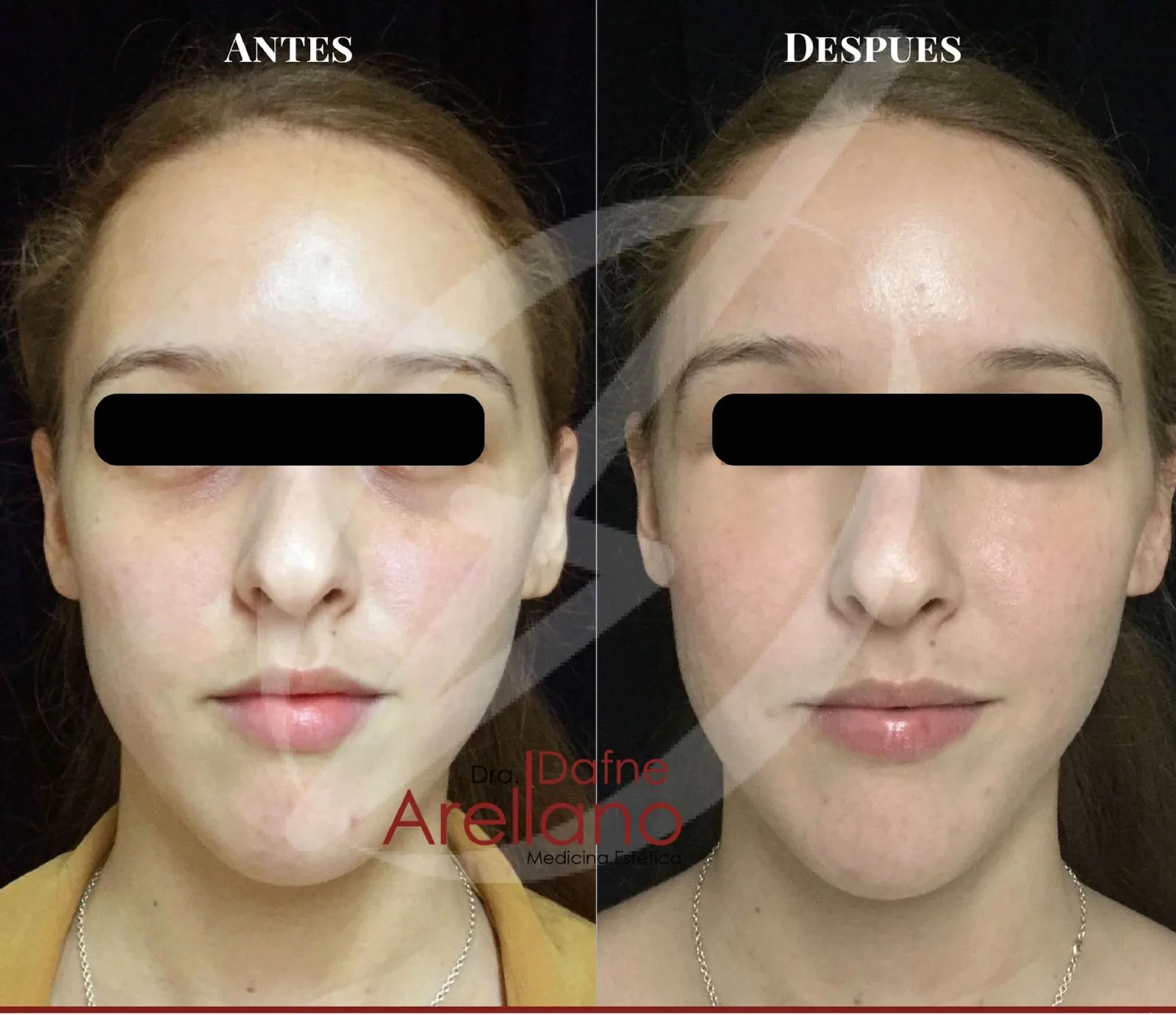 Antes y después · Ojeras