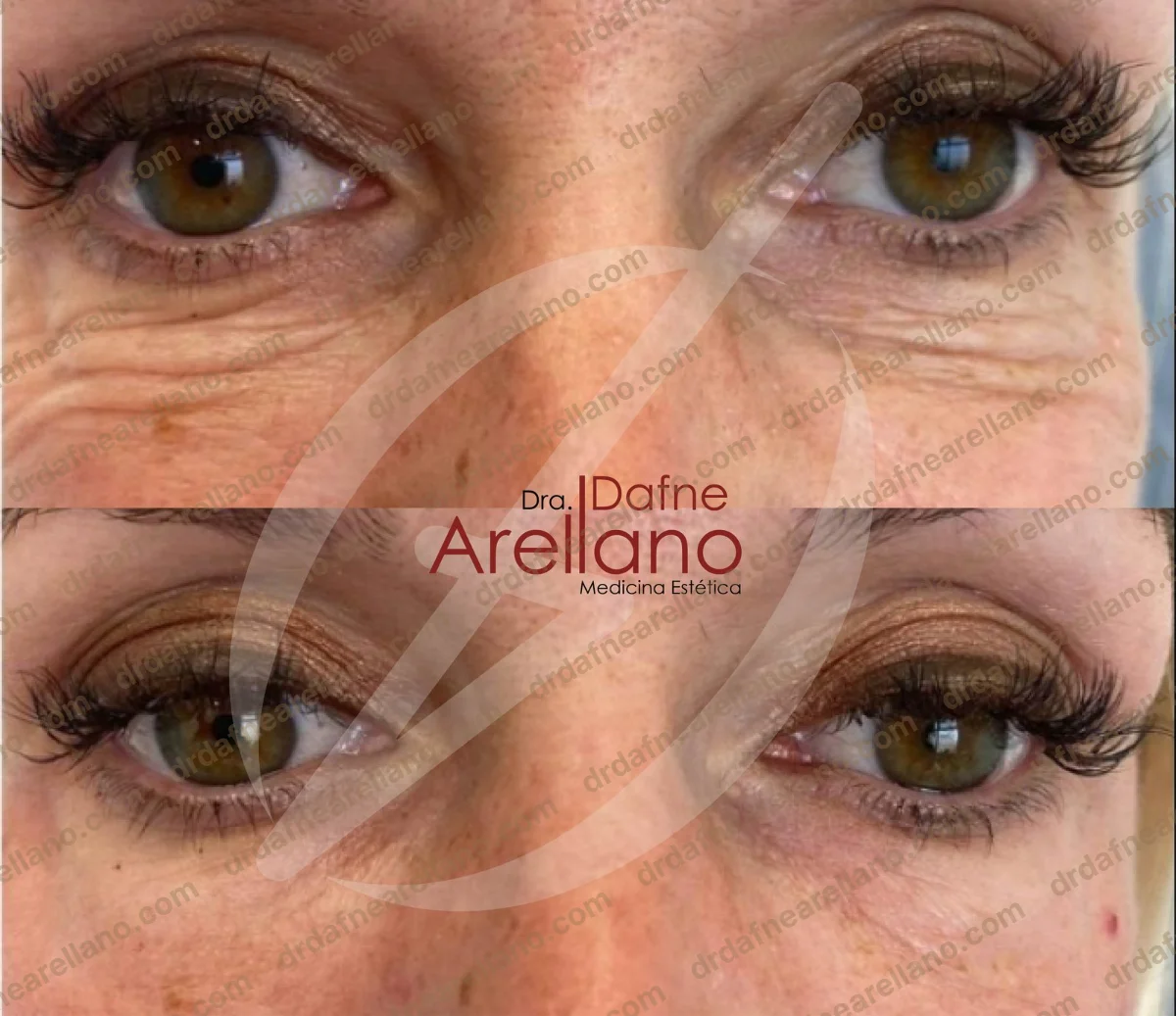 Antes y después — Tratamiento de Ojeras en Puebla