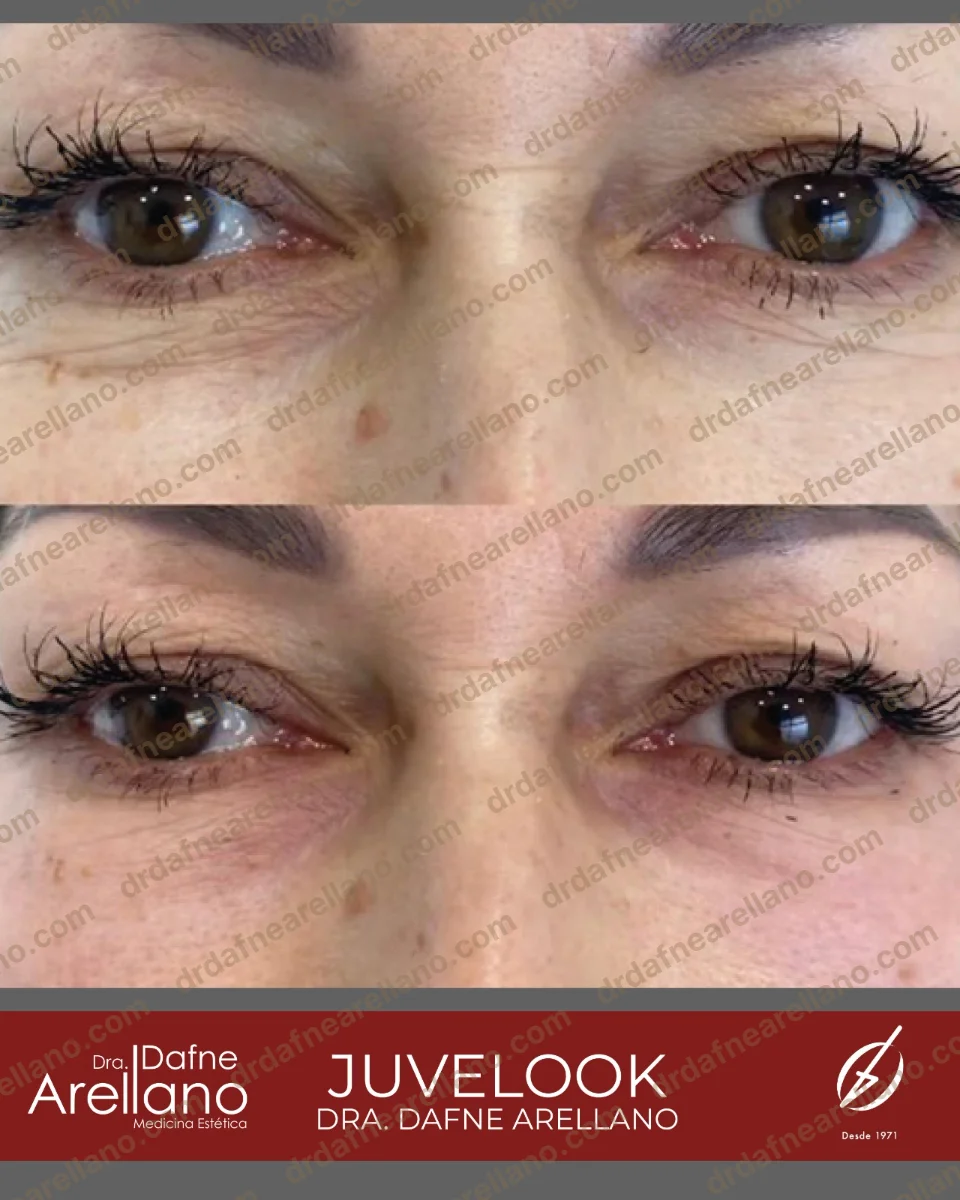 Antes y después — Tratamiento de Ojeras en Puebla