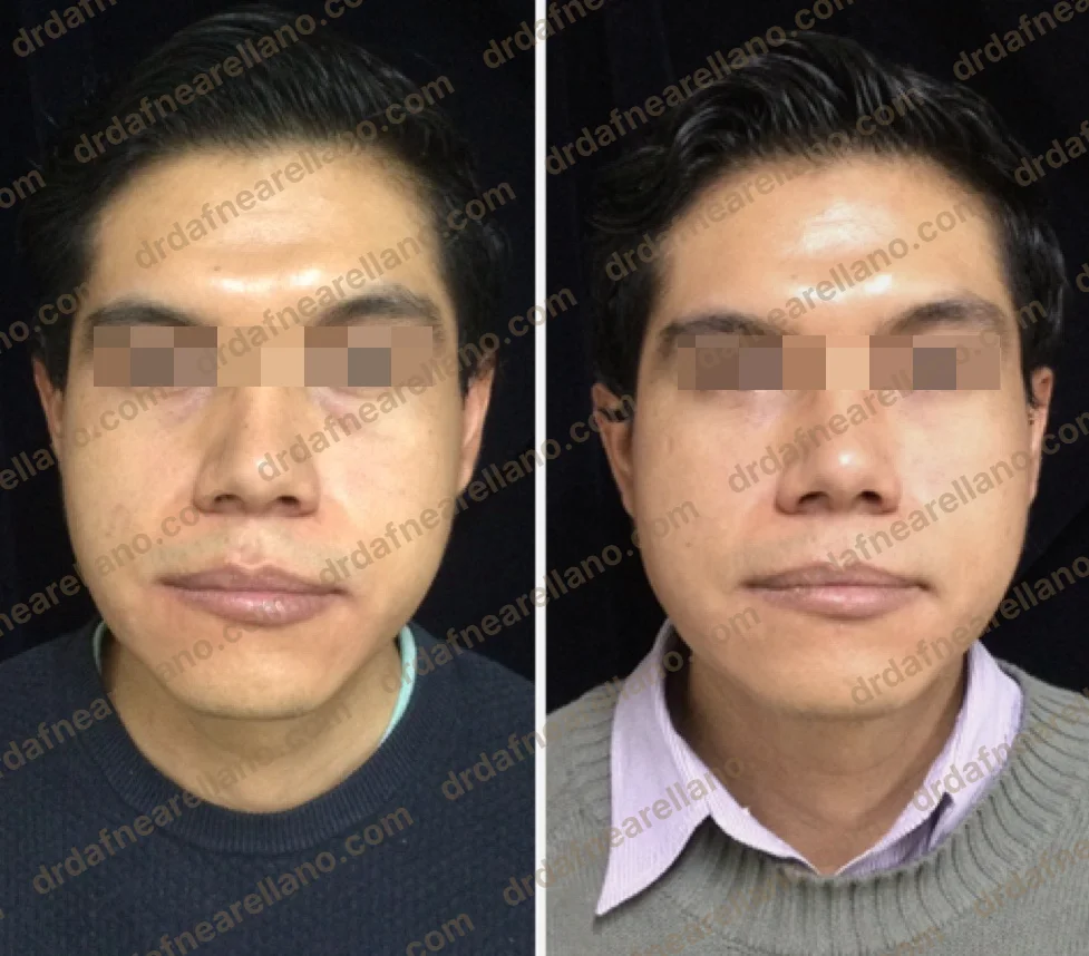 Antes y después — Tratamiento de Ojeras en Puebla