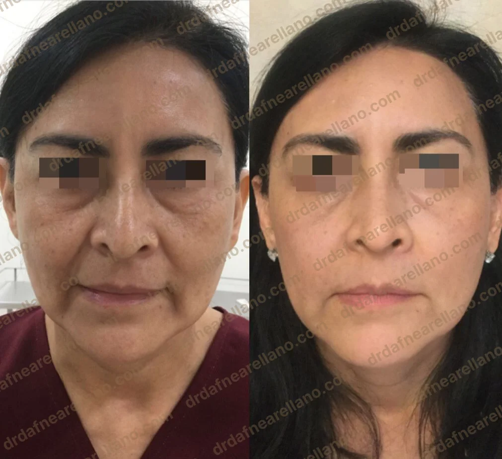 Antes y después — Tratamiento de Ojeras en Puebla
