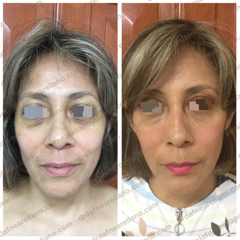 Antes y después — Tratamiento de Ojeras en Puebla