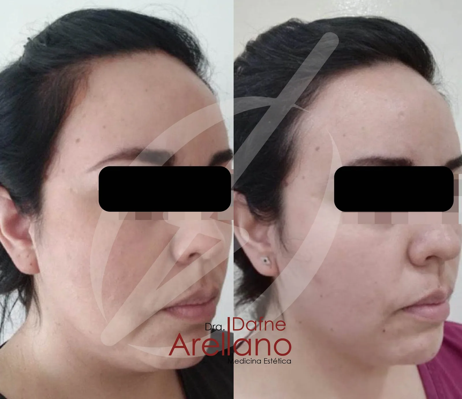 Antes — Tratamiento de Papada en Puebla