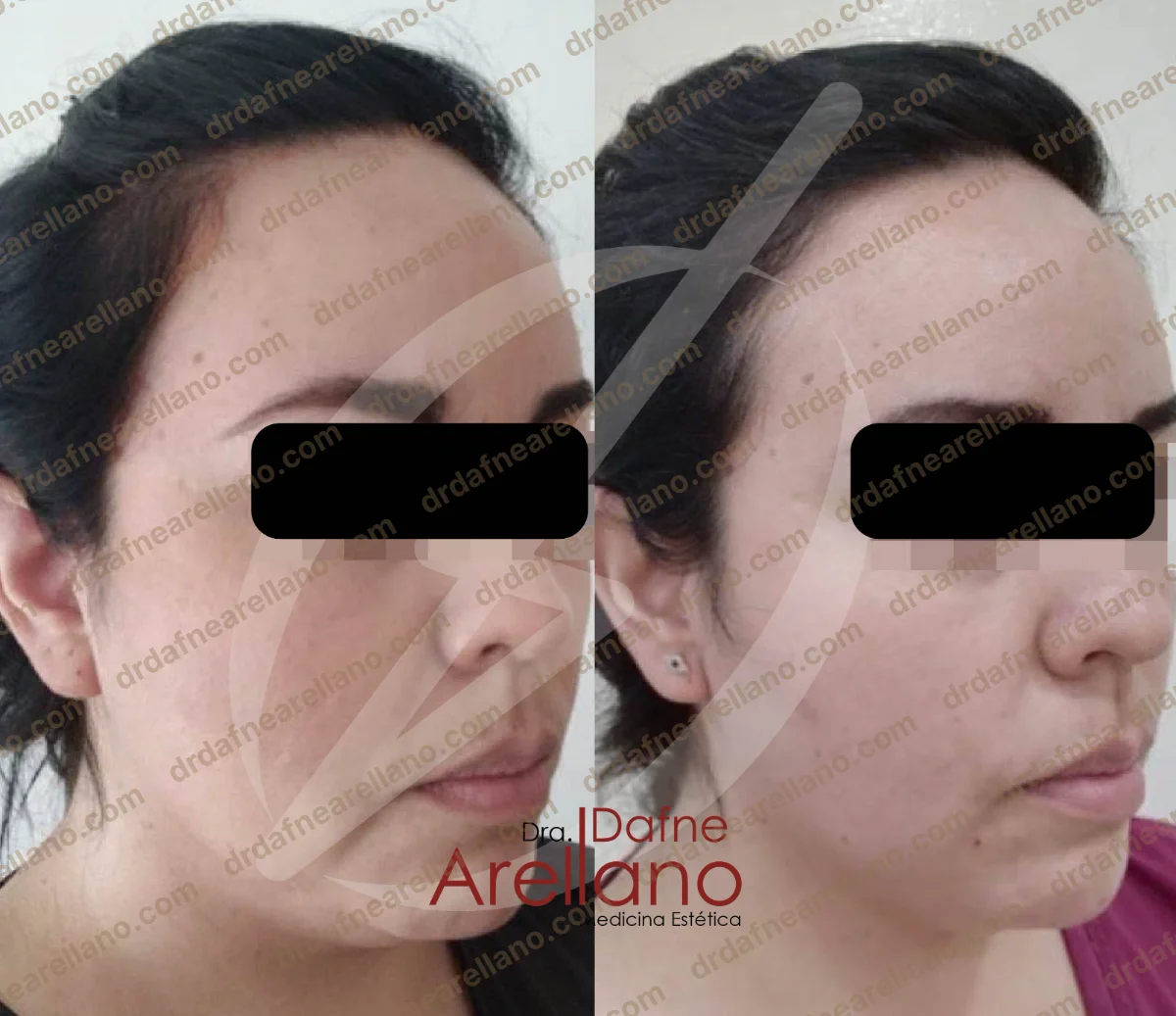 Antes y después — Tratamiento de Papada en Puebla