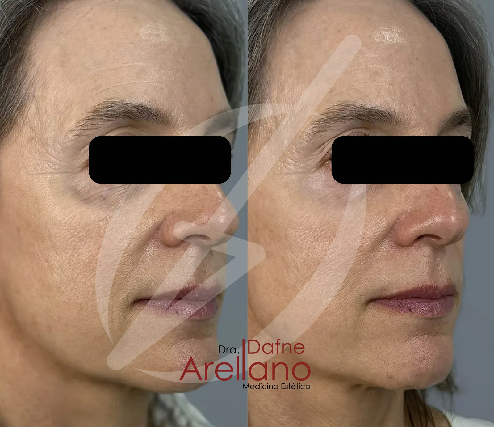 Antes y después · Pdrn Polinucleotidos