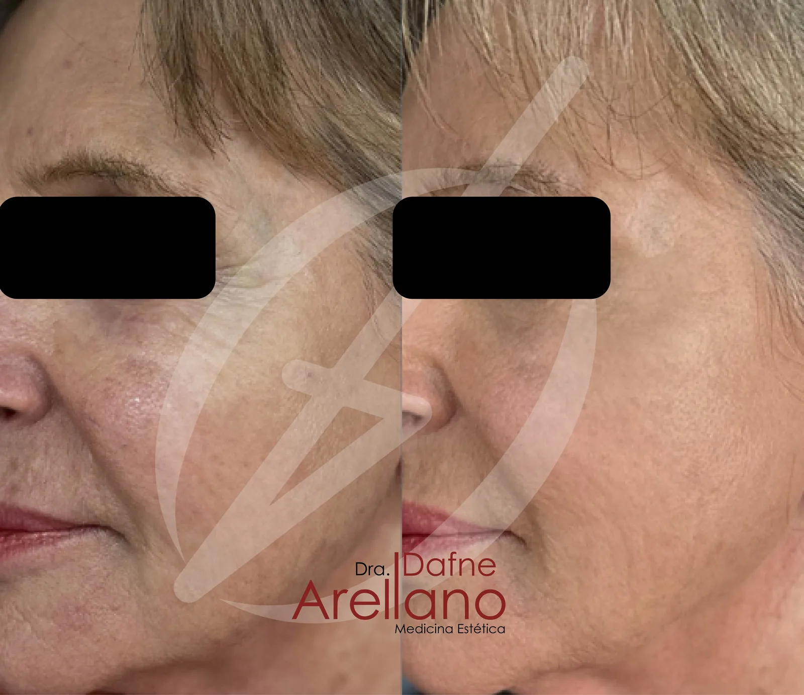 Antes y después · Pdrn Polinucleotidos