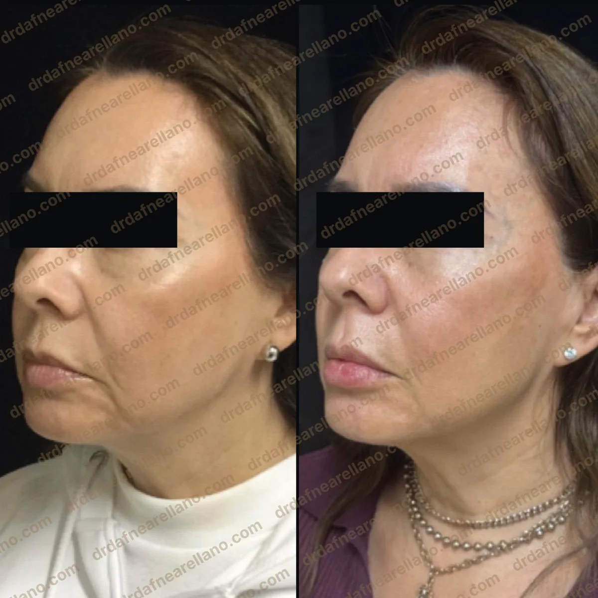 Antes y después — Profhilo en Puebla