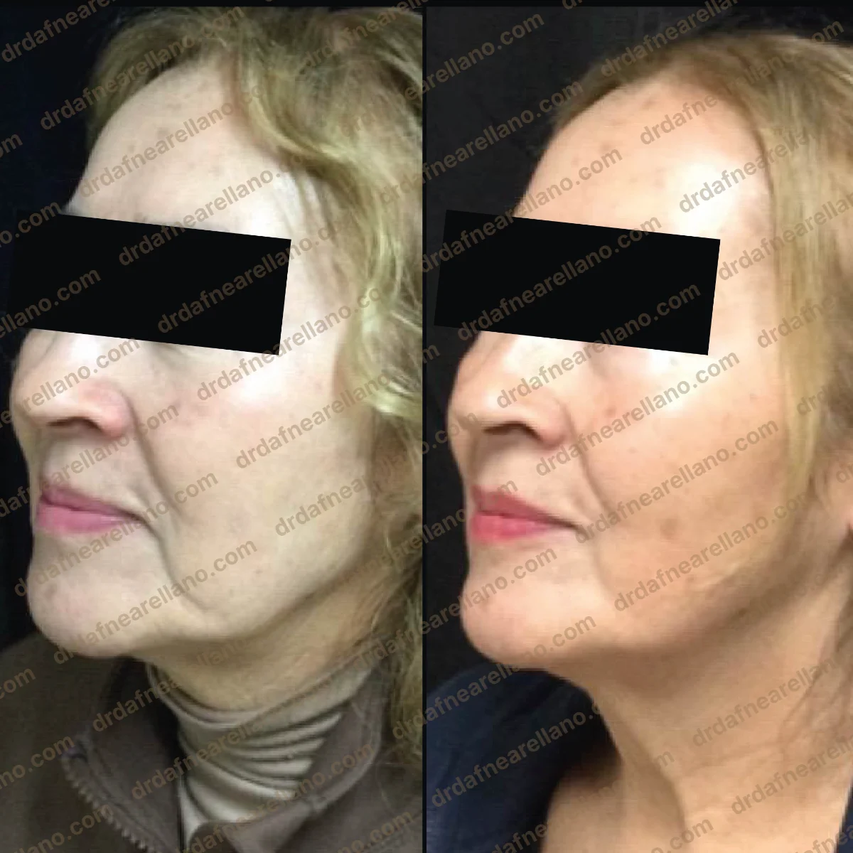 Antes y después — Profhilo en Puebla