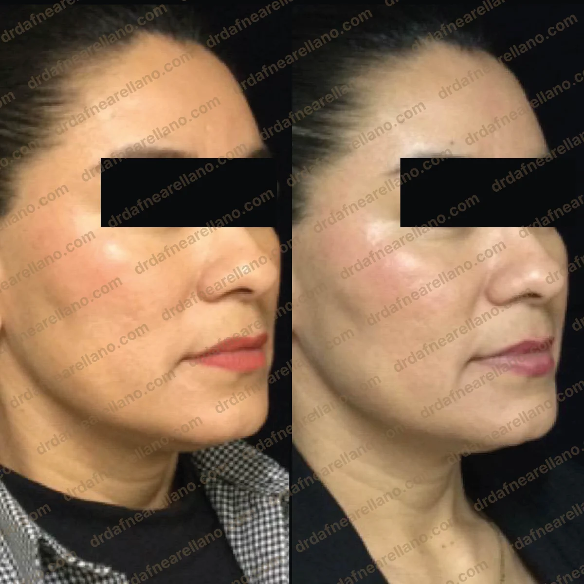 Antes y después — Profhilo en Puebla