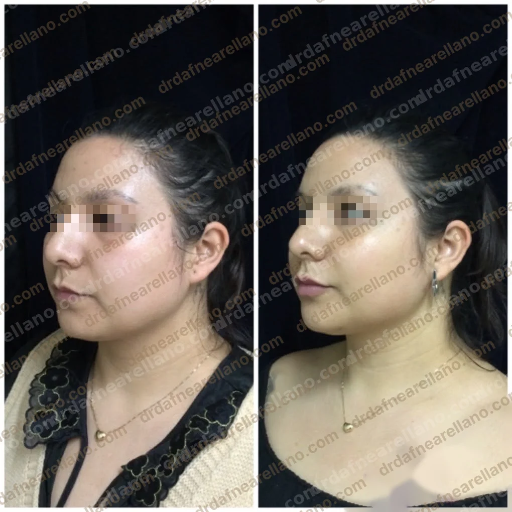 Antes y después — Profhilo en Puebla