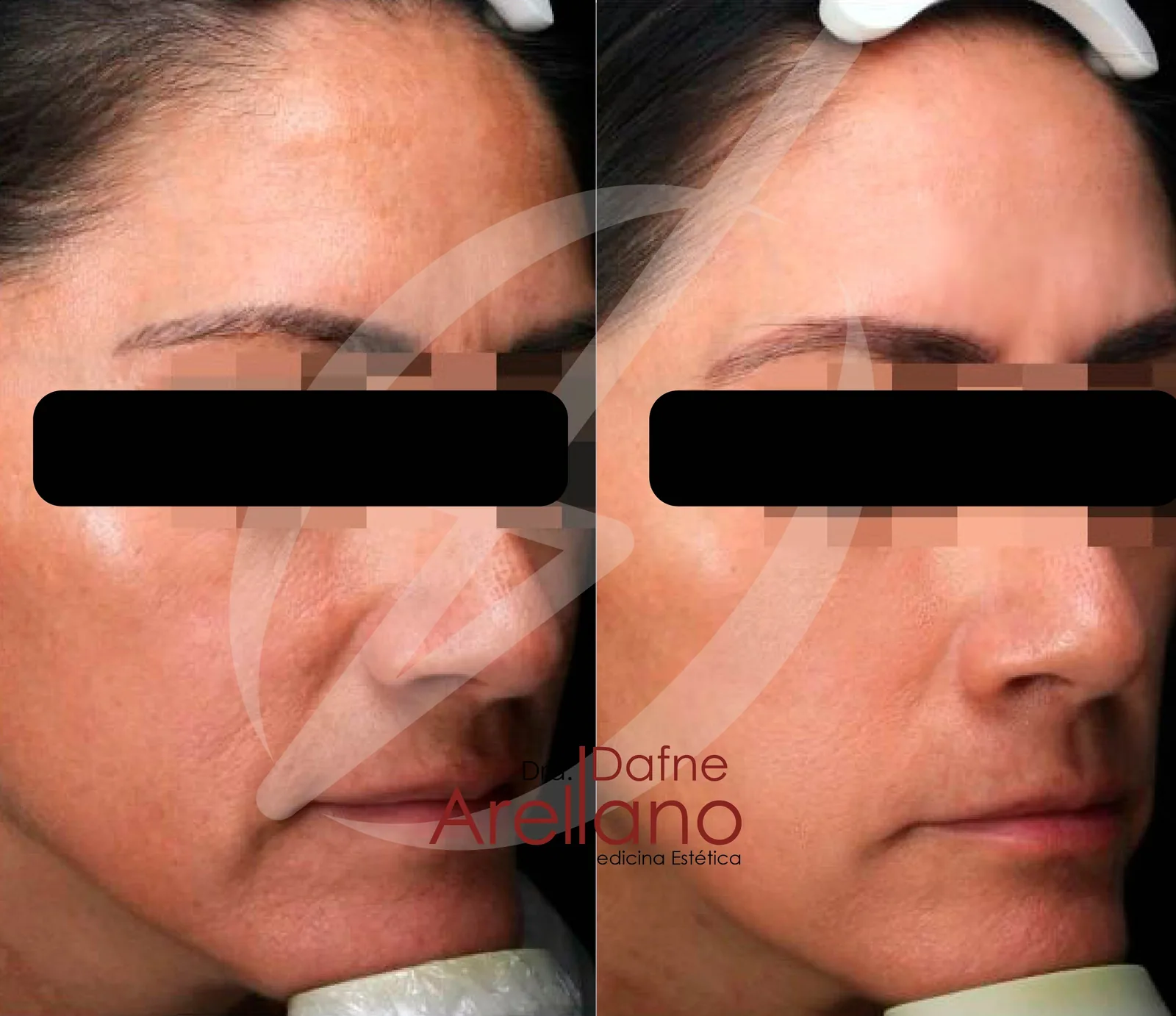 Antes — Rejuvenecimiento Láser en Puebla