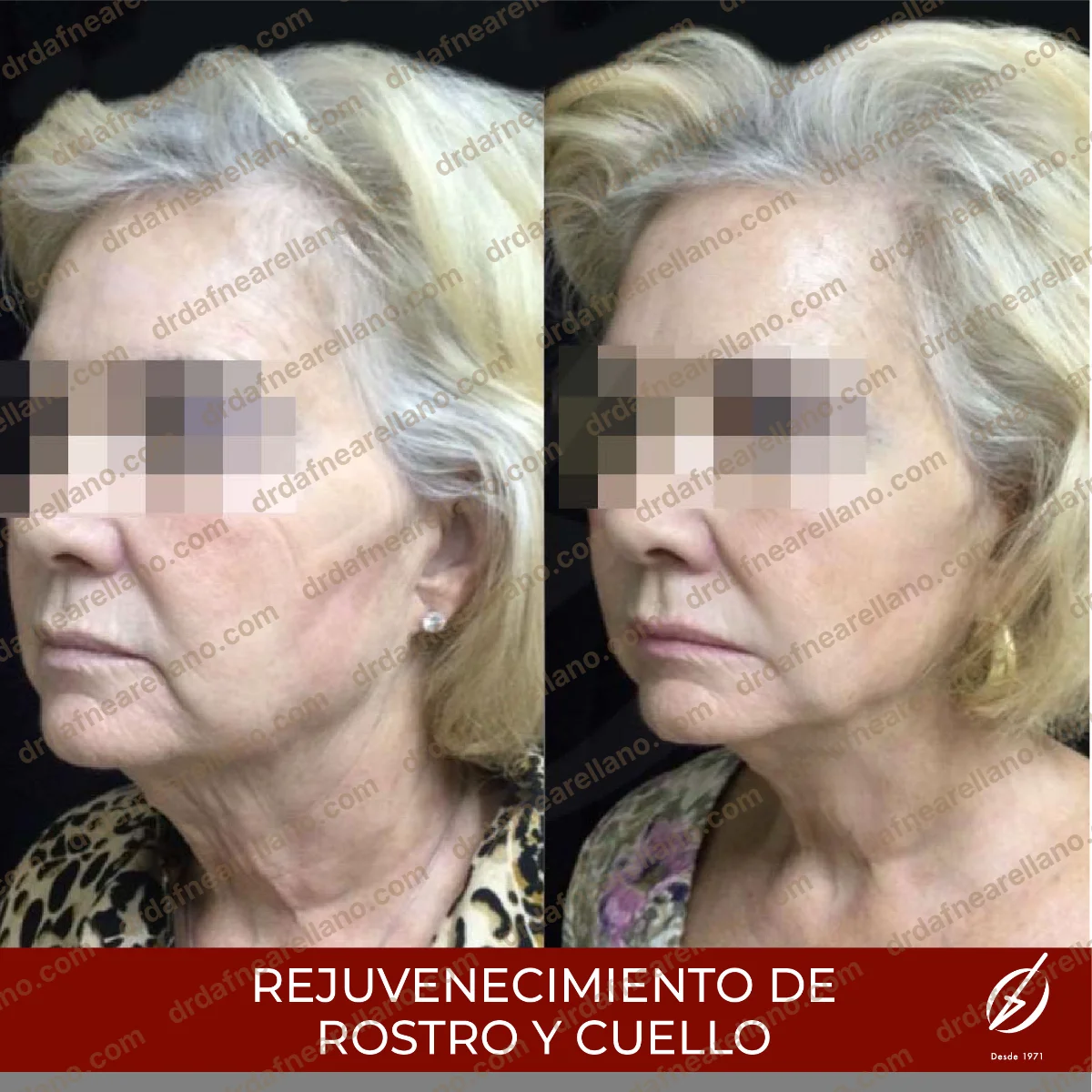 Antes y después — Rejuvenecimiento Láser en Puebla