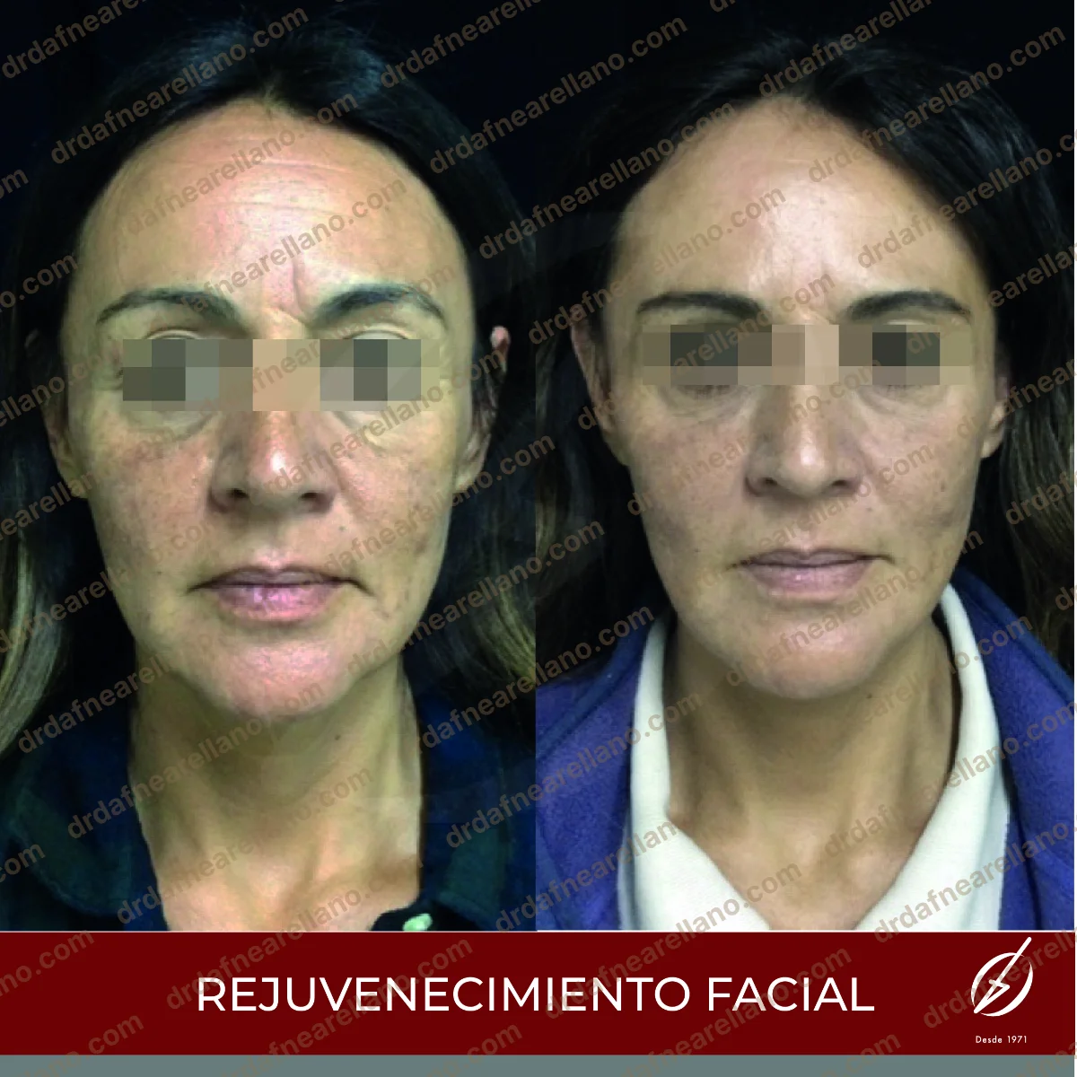 Antes y después — Rejuvenecimiento Láser en Puebla