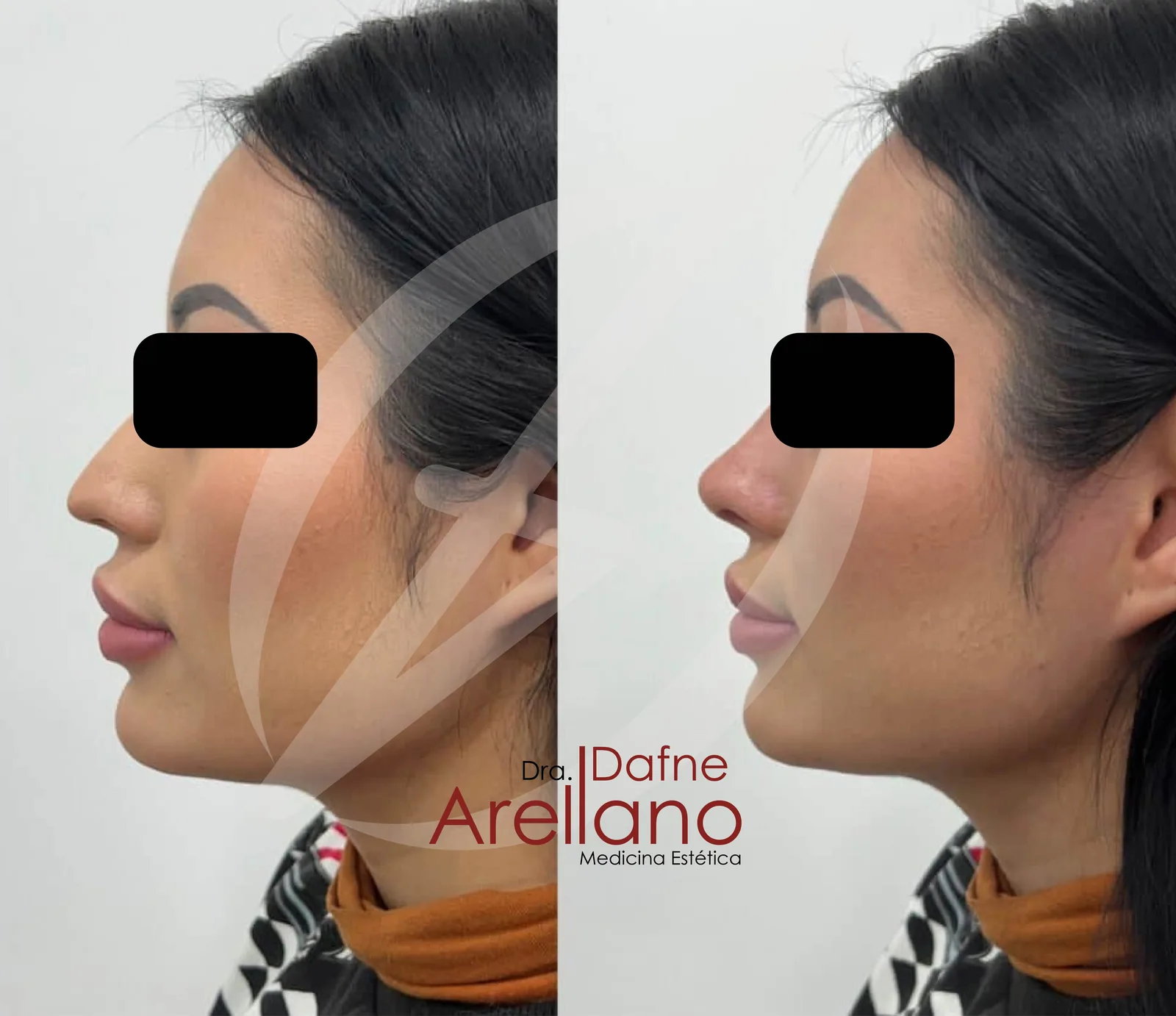 Antes — Rinomodelación en Puebla