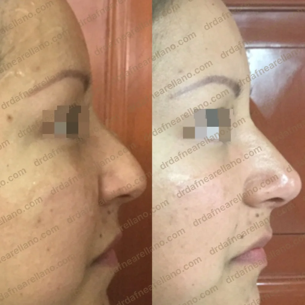 Antes y después — Rinomodelación en Puebla