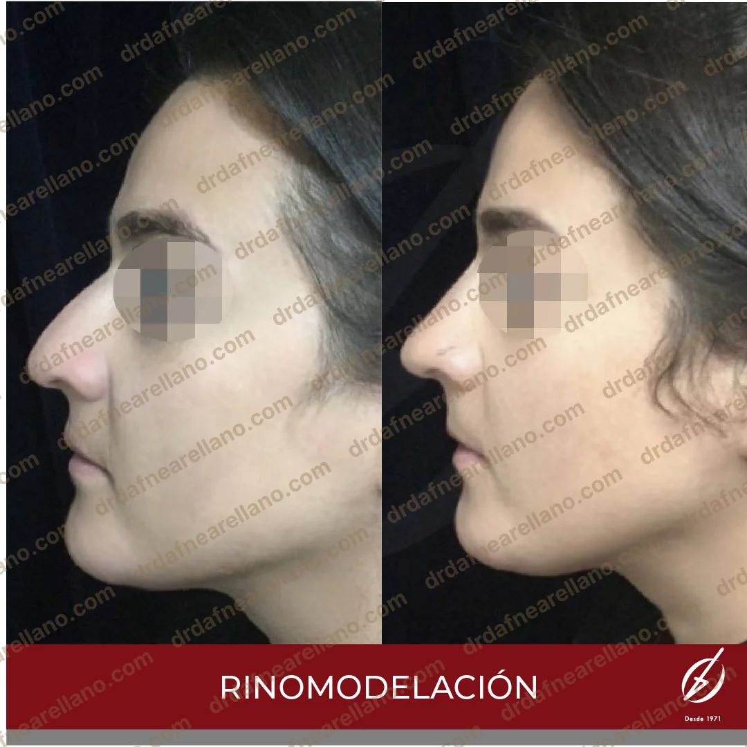 Antes y después — Rinomodelación en Puebla