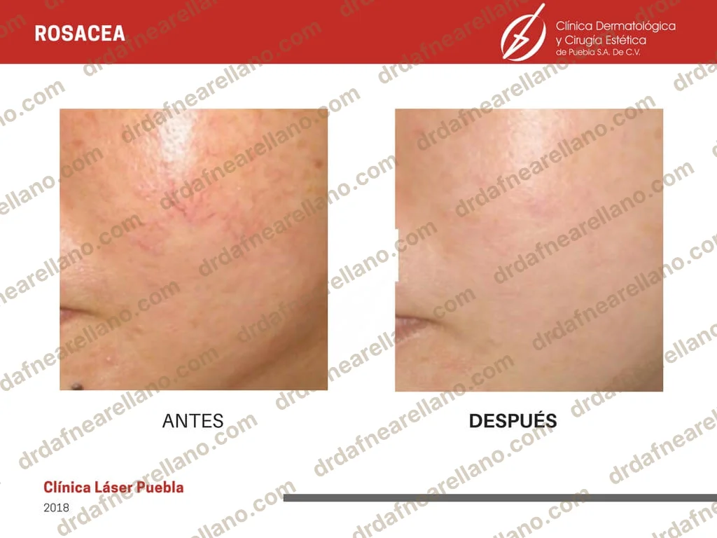 Antes y después — Tratamiento de Rosácea en Puebla