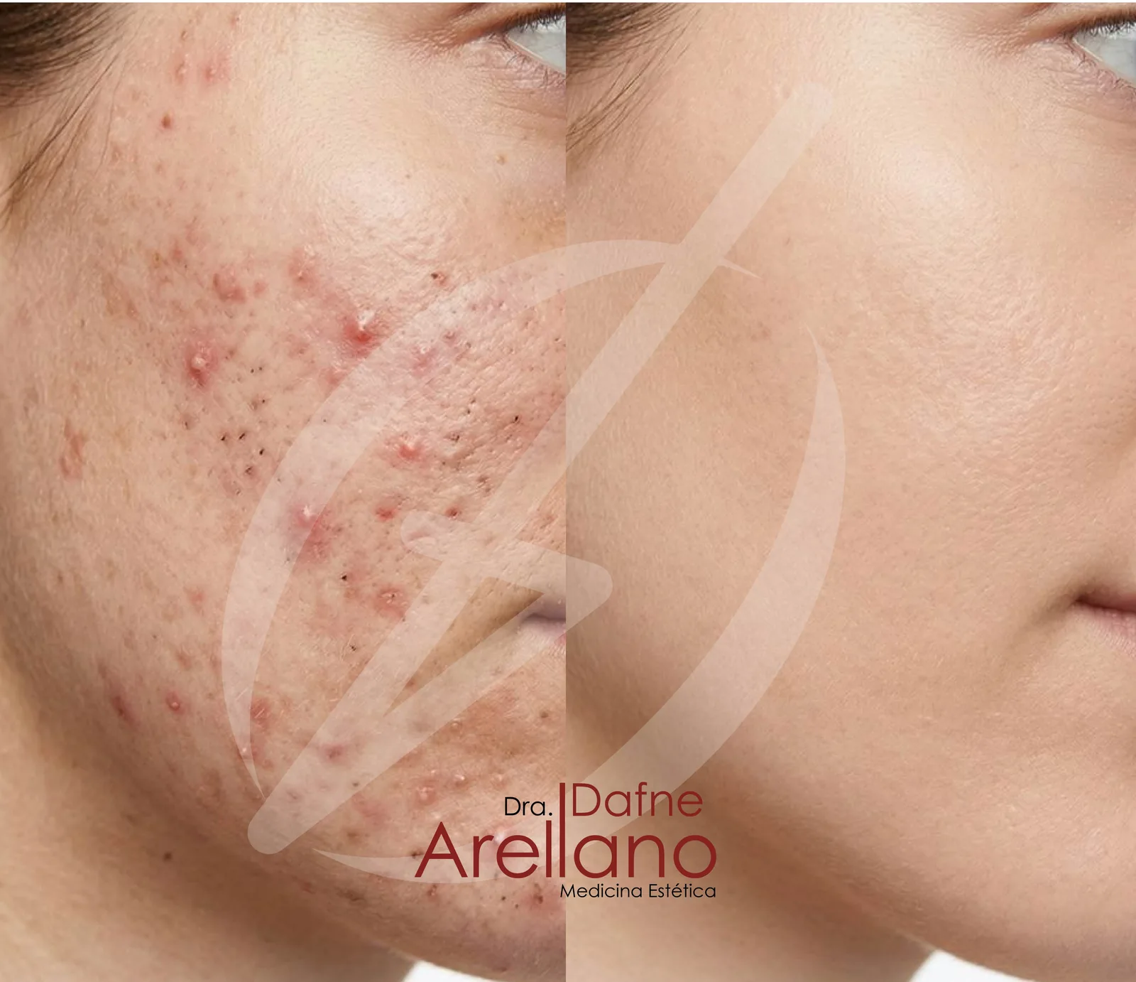 Después — Skin Resurfacing pHformula en Puebla