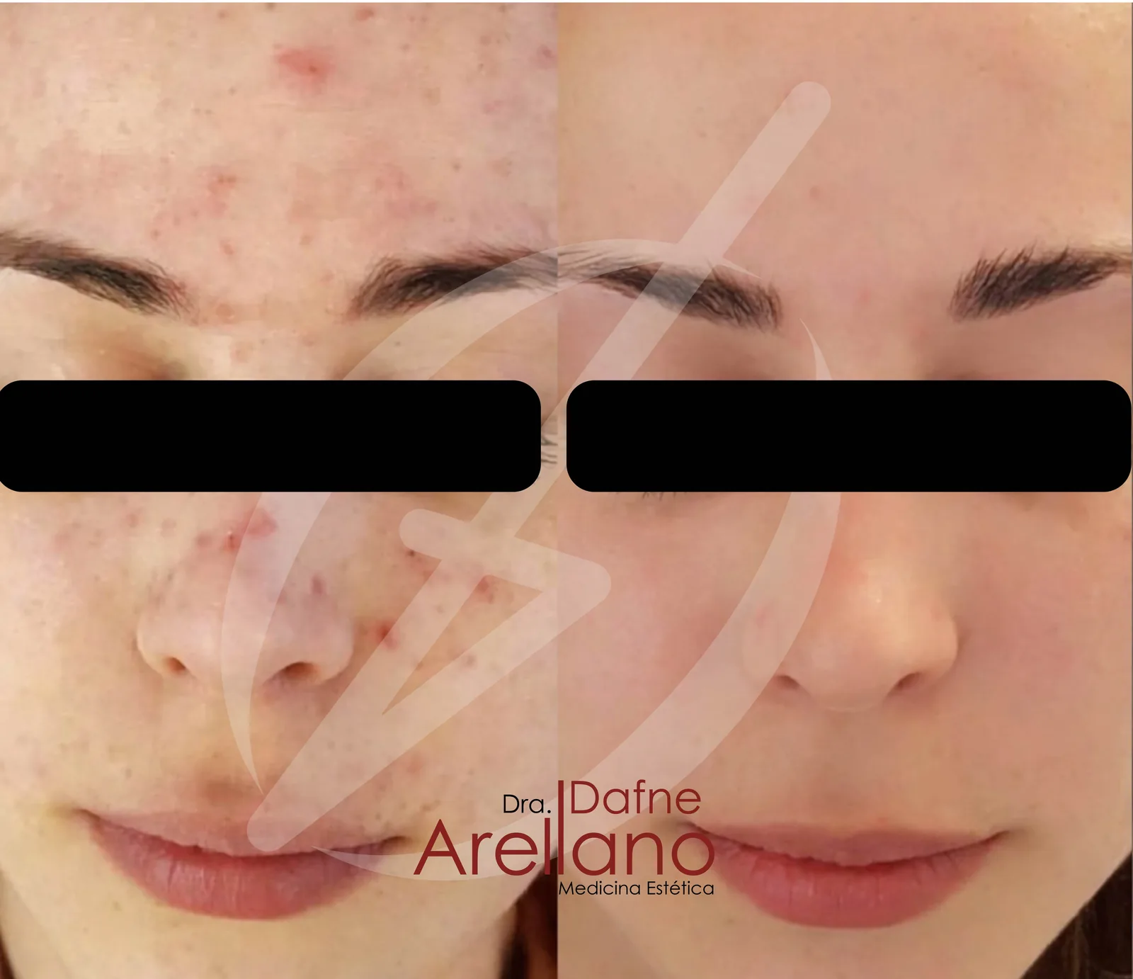 Antes — Skin Resurfacing pHformula en Puebla
